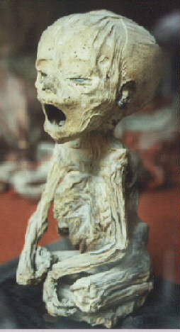 Mummified foetus